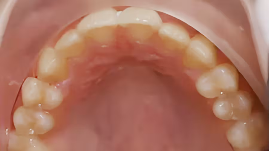 kid teeth with over crowding after treatment