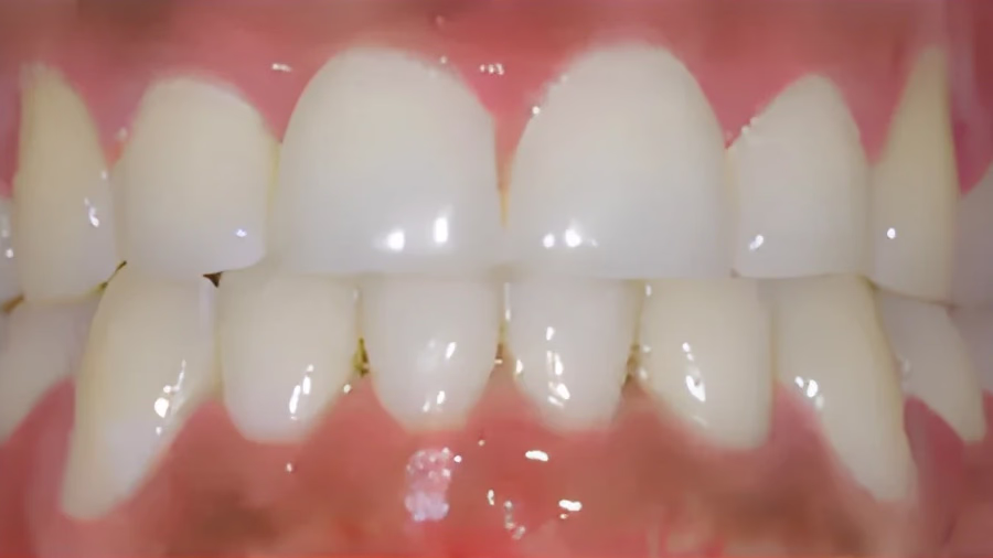 patient after underbite treatment