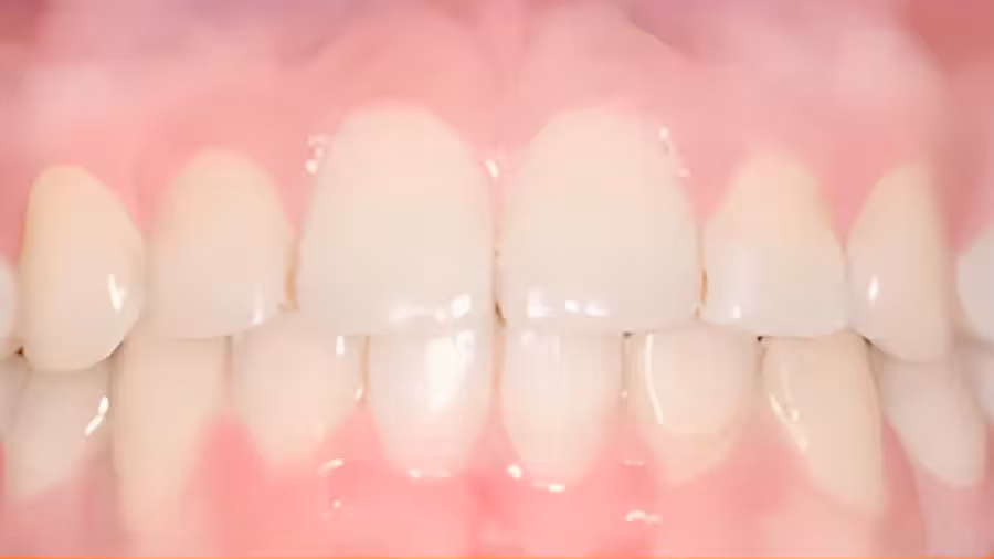 teeth overlap after treatment