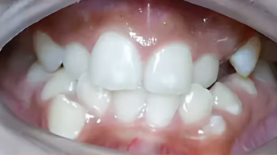 upper and lower teeth overcowding