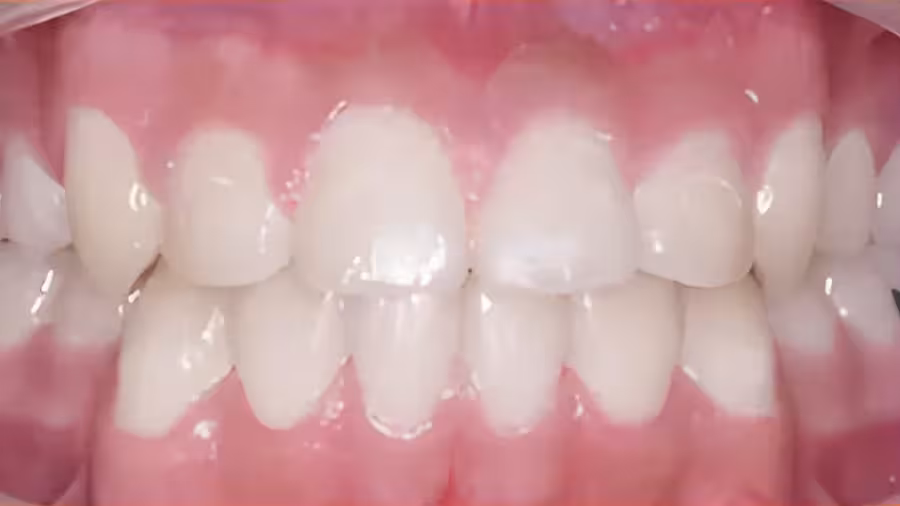 upper and lower teeth over crowding after treatment