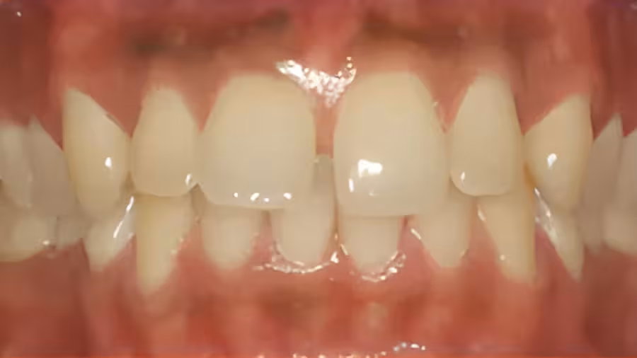 teeth with spacing problems